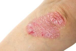 What is Eczema and Do you have it?