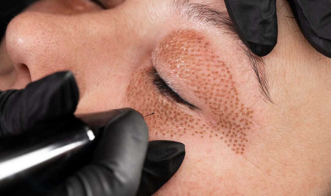 Fibroblast – What is it?